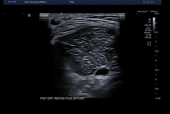 Quand des "tendinopathies achilléennes" cachent un piège poplité : l’importance de l’échographie dynamique et de l'examen clinique concomitant