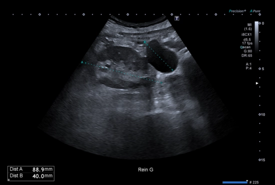 Echographie abdominale dans un contexte de surveillance de cirrhose
