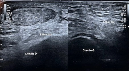 Echographie de la face antérieure de la cheville