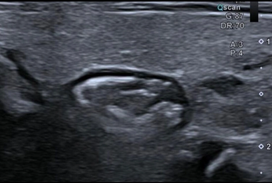 Échographie thyroïdienne