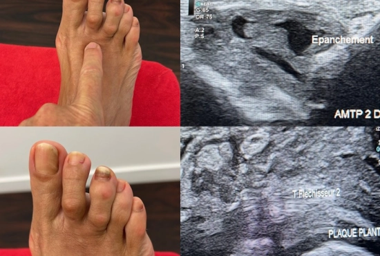 Échographie du pied